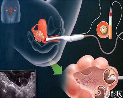 宫外孕早期有哪些症状？什么人容易宫外孕