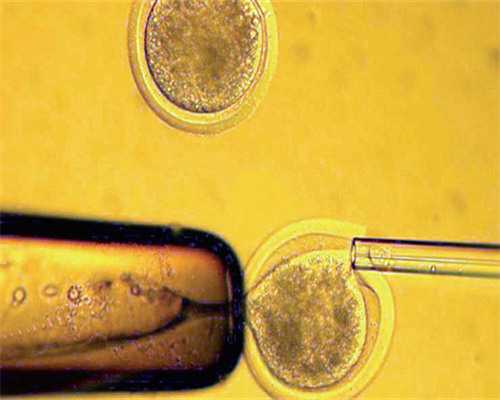 孕妇做盆腔彩超需要憋尿吗_腹部彩超和盆腔彩超是否需要憋尿~借卵子代怀