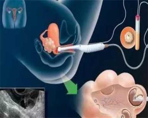 广州供卵三代试管套路揭晓！选择机构需实地考察